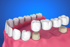 illustration of a traditional dental bridge replacing 2 missing teeth
