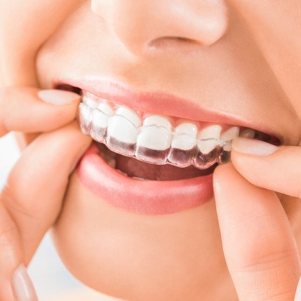 Smiling woman putting clear aligner on top teeth